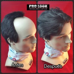 Antes y Después Prótesis Capilares