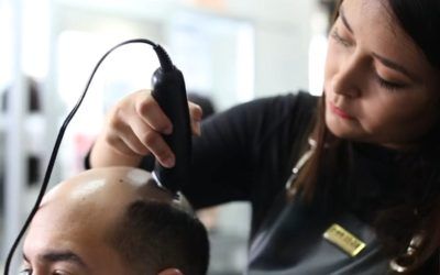 ¿Es Bueno usar Prótesis Capilares cuando Sufro de Alopecia?
