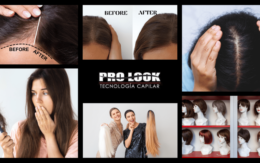 Alopecia Femenina. Motivos para usar Topper o Pelucas.