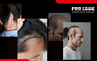 Alopecia Cicatricial. ¿Cómo solucionar con prótesis capilares?